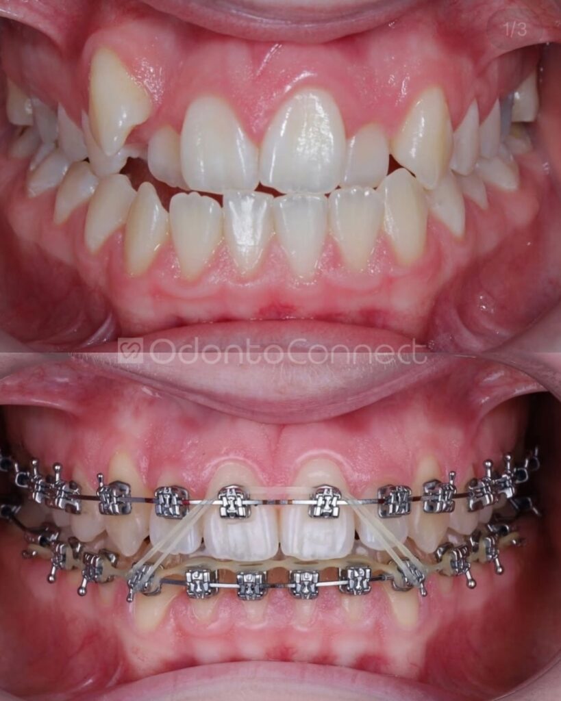 Cada sorriso tem uma história e essa está só começando.Início do tratamento ortodôntico com foco