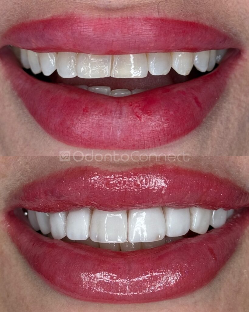 O antes e depois que fala por si.Mais do que estética, é técnica, planejamento e respeito pela h (1)