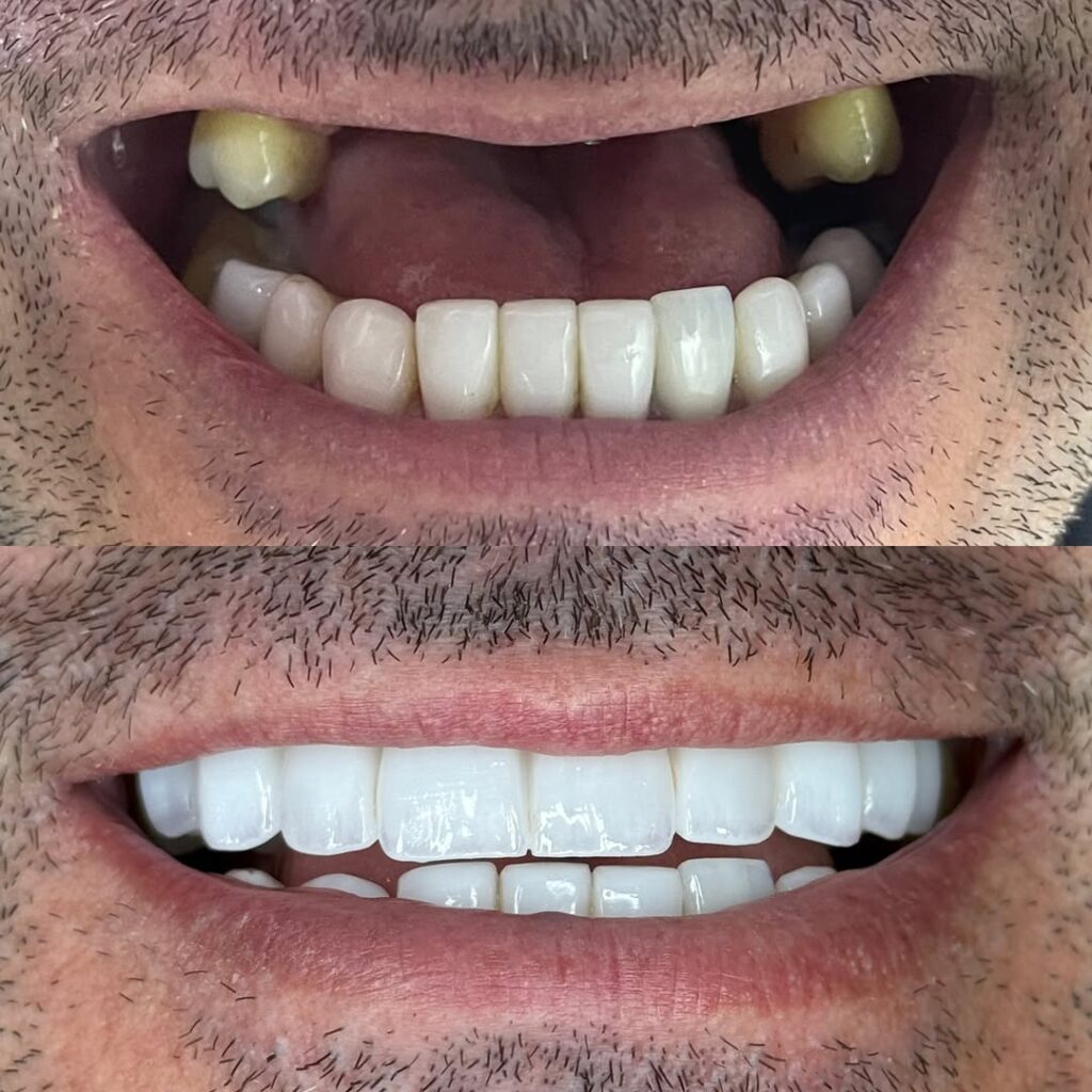 Um sorriso novo, fixo e cheio de autoestima!Nesse caso, dissemos adeus à prótese removível!Reali