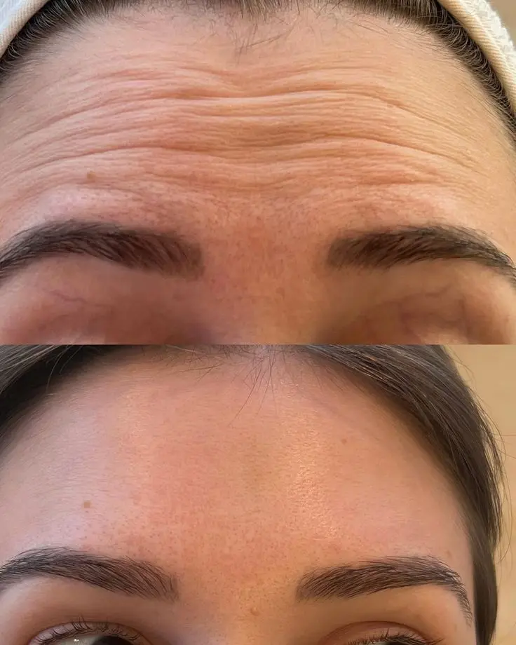 BOTOX 2
