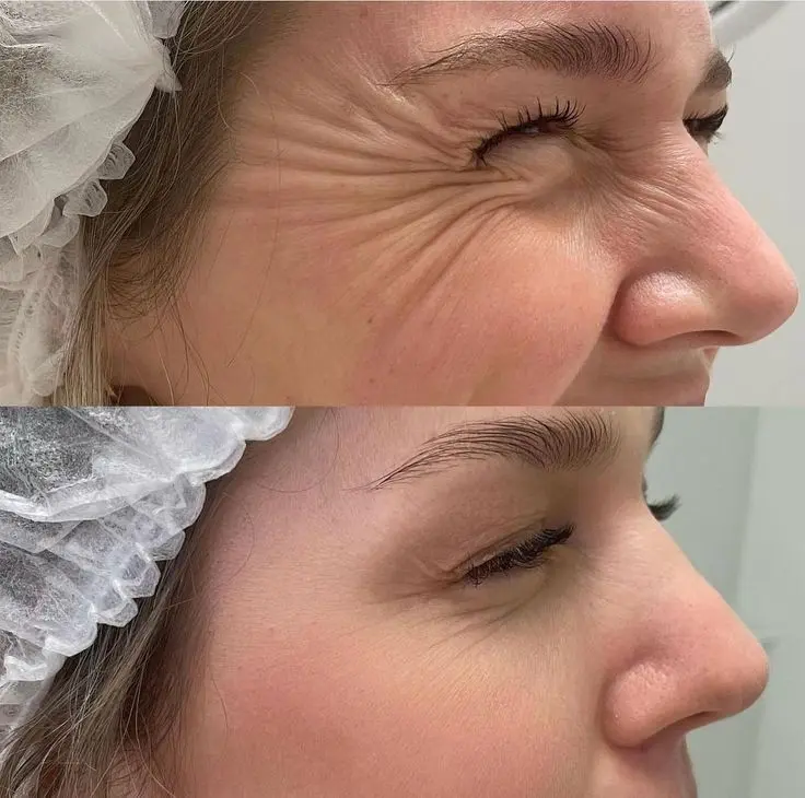 BOTOX 3