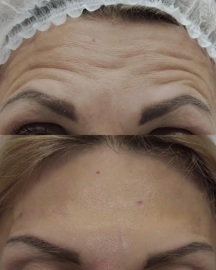 BOTOX 4