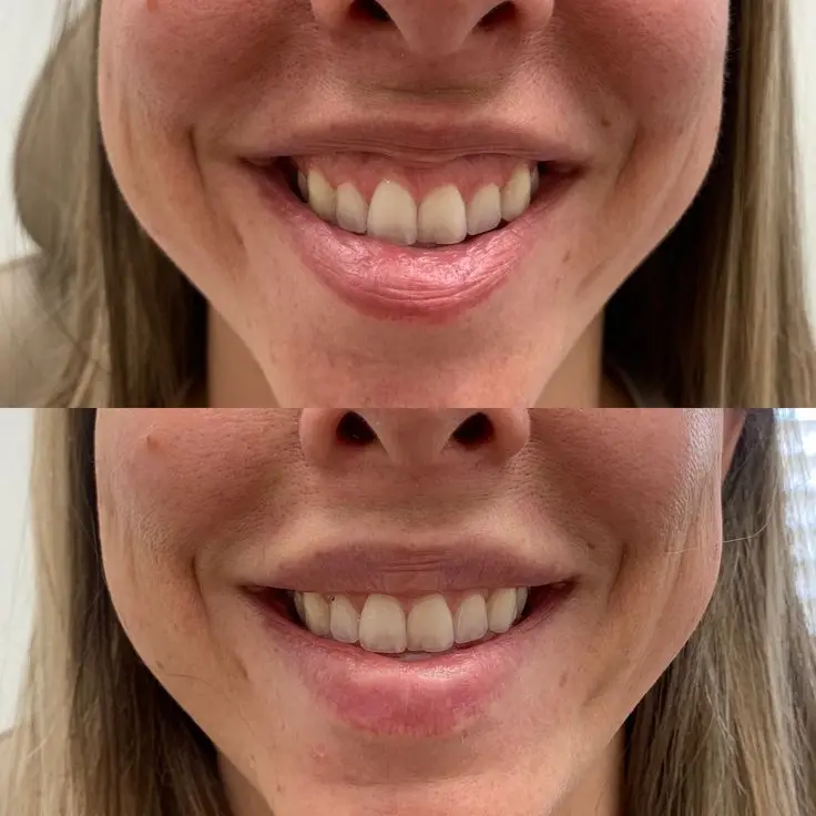 BOTOX 5