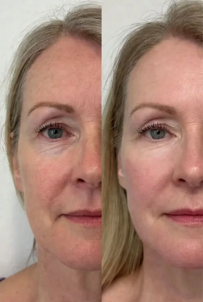 Before _ After _ BOTOX