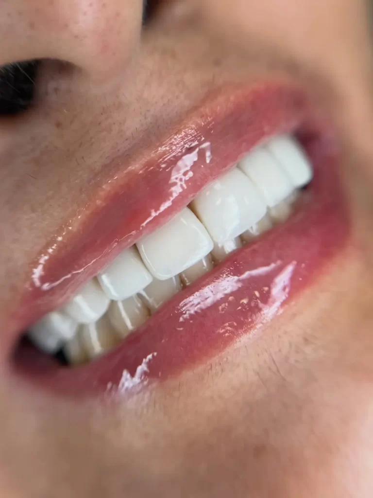 Na Odontoconnect, cada caso é tratado com atenção e cuidado. Neste retrabalho, preservamos ao má (4)