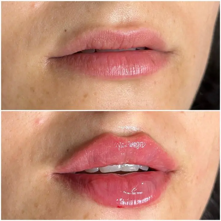 P. LABIAL 2