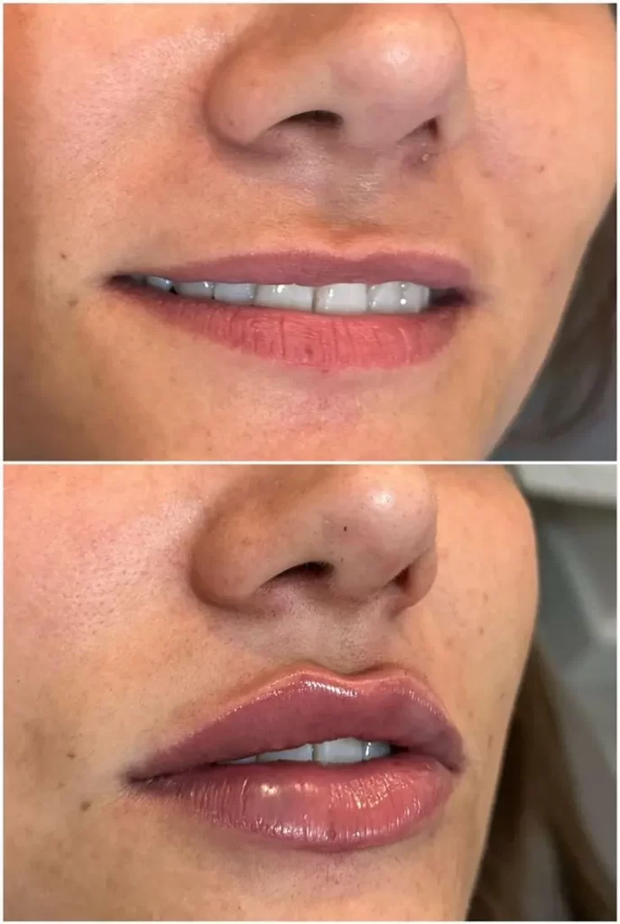 P. LABIAL 4