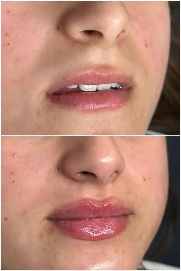 P. LABIAL 5